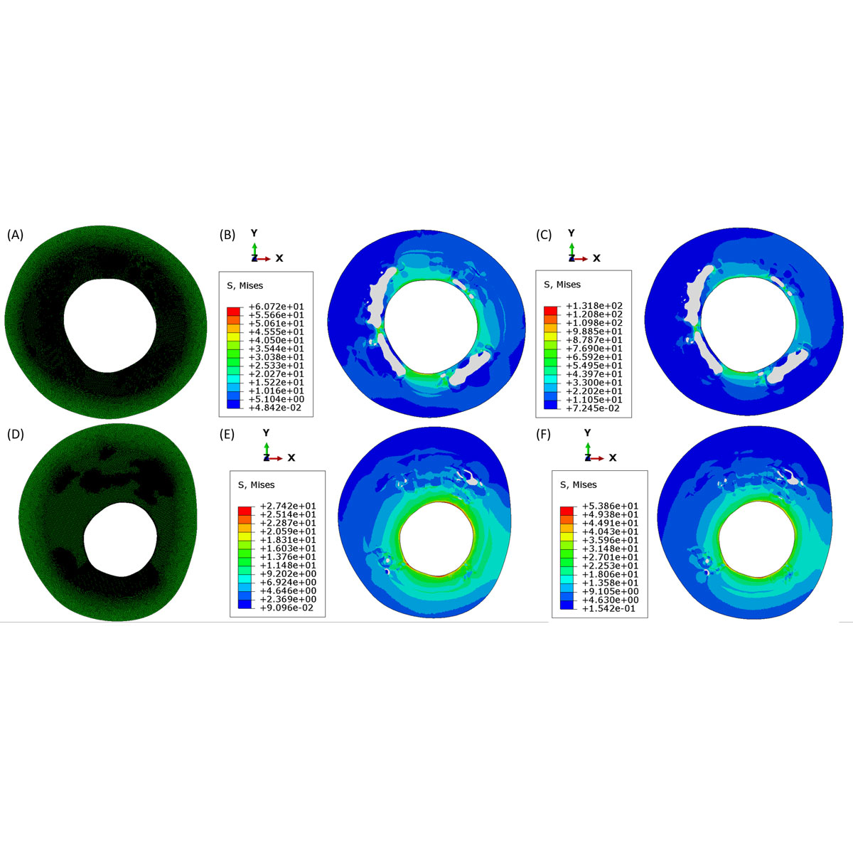 FEM_coronary_plaque