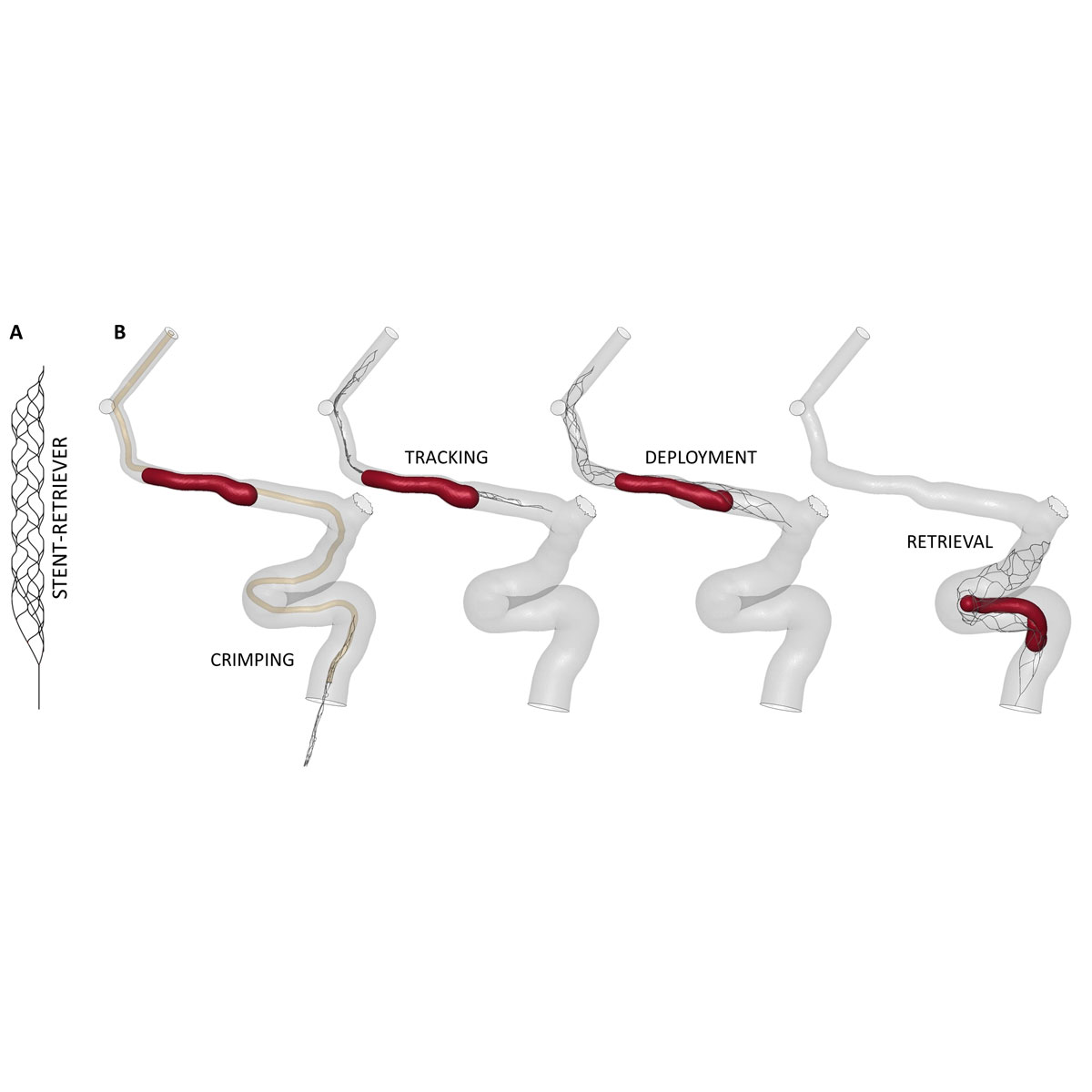 thrombectomy_1